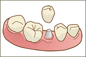 インプラント治療